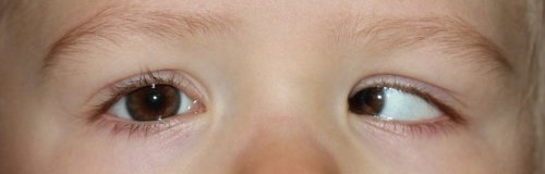 Unterschiedlich große augen baby Ein Auge